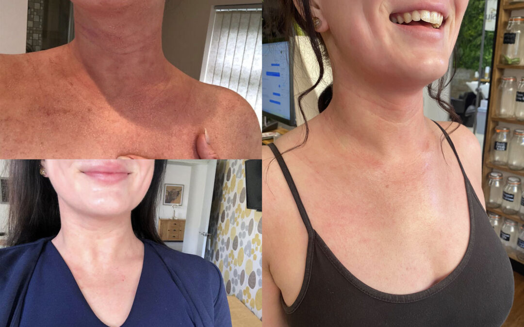 Becky Bugler – Eczema sufferer